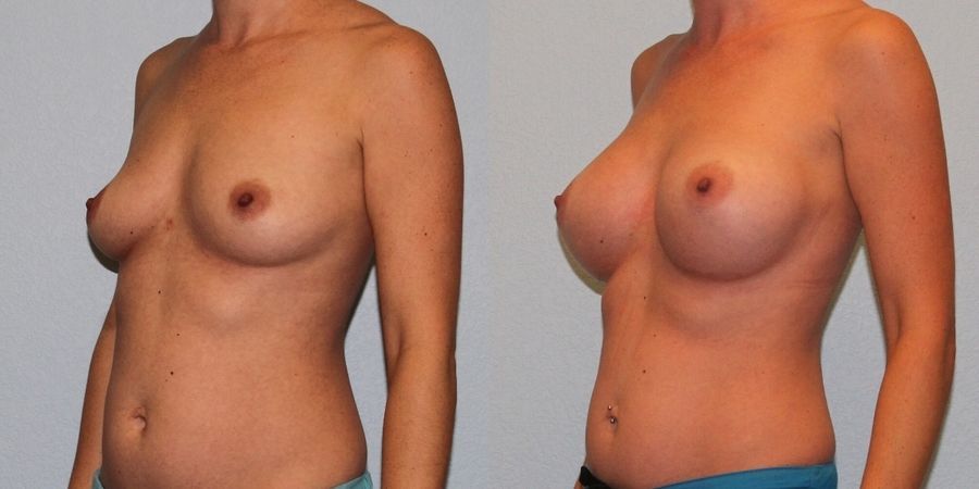 Breast Augmentation - Thumbnail 2