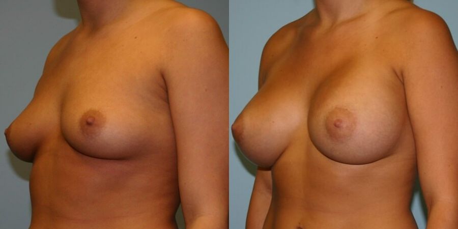 Breast Augmentation - Thumbnail 2