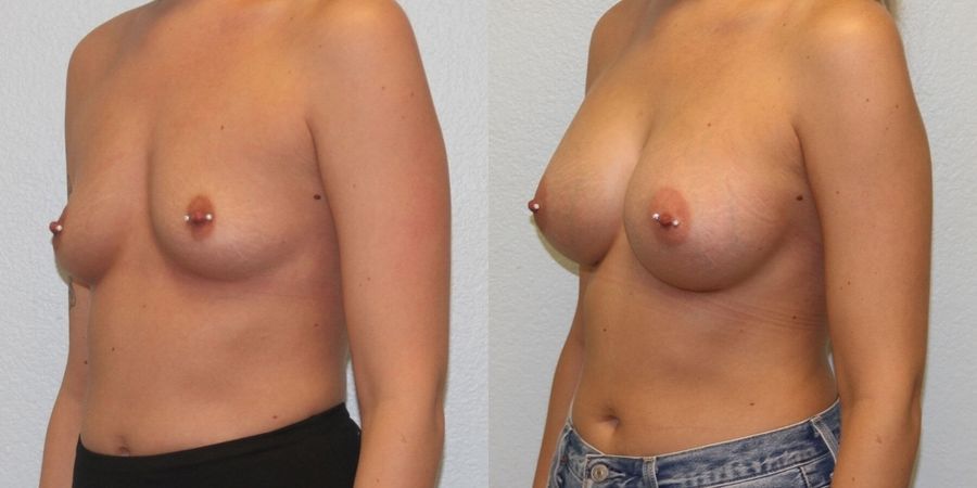 Breast Augmentation - Thumbnail 2