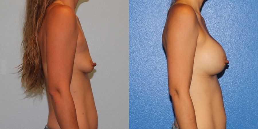 Breast Augmentation - Thumbnail 3