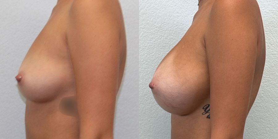 Breast Augmentation - Thumbnail 3