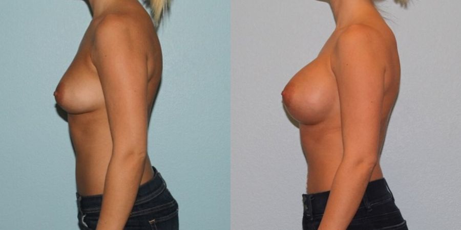 Breast Augmentation - Thumbnail 3