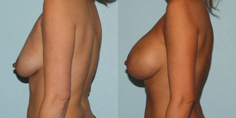Breast Augmentation - Thumbnail 3