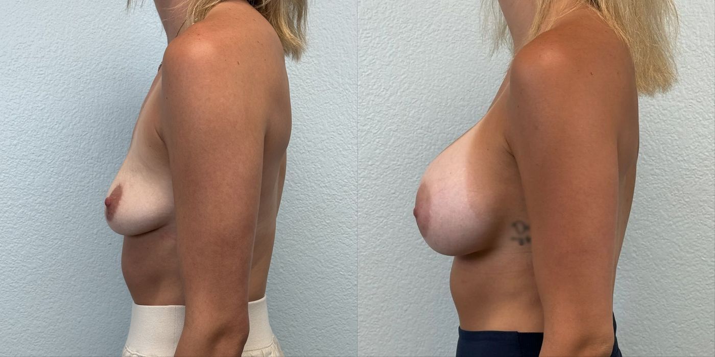 Breast Augmentation - Thumbnail 3