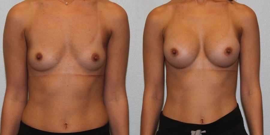 Breast Augmentation - Case 19318