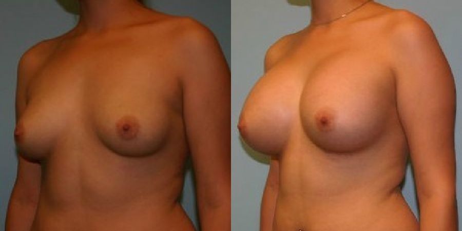 Breast Augmentation - Thumbnail 2