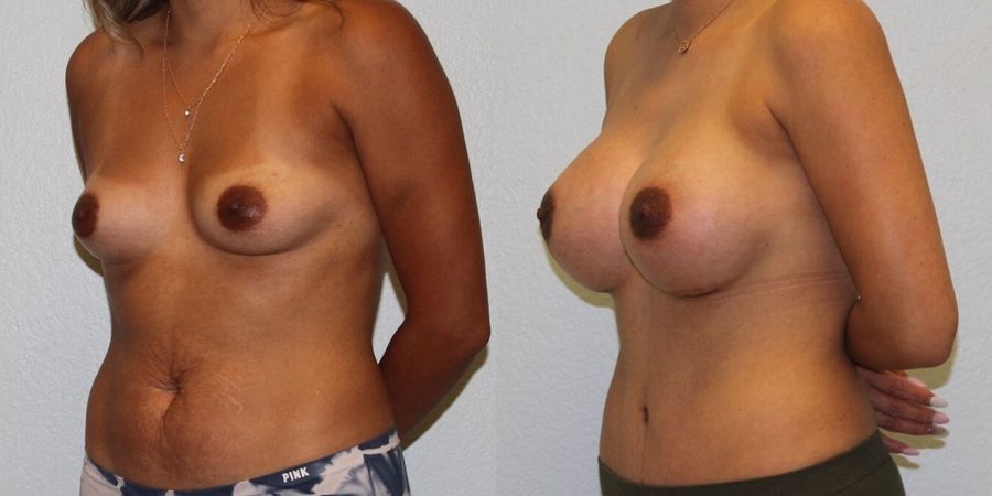 Breast Augmentation - Thumbnail 2