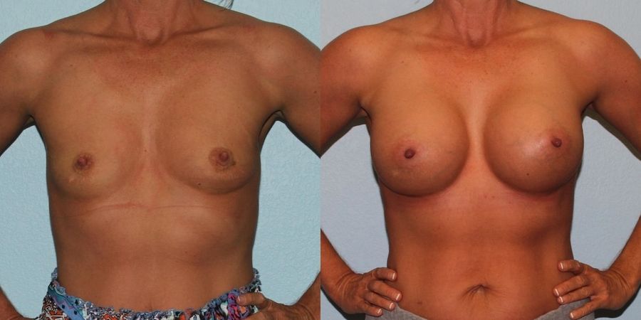 Breast Augmentation - Case 19286