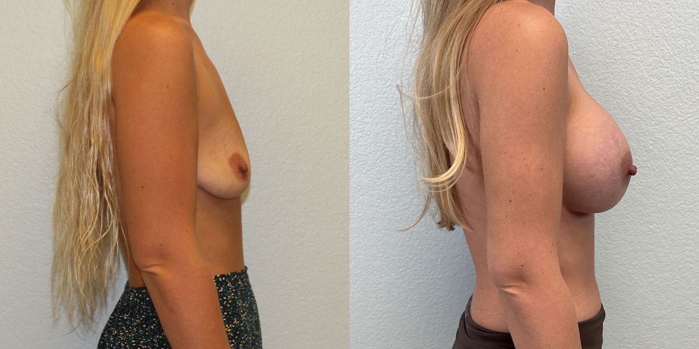 Breast Augmentation - Thumbnail 3