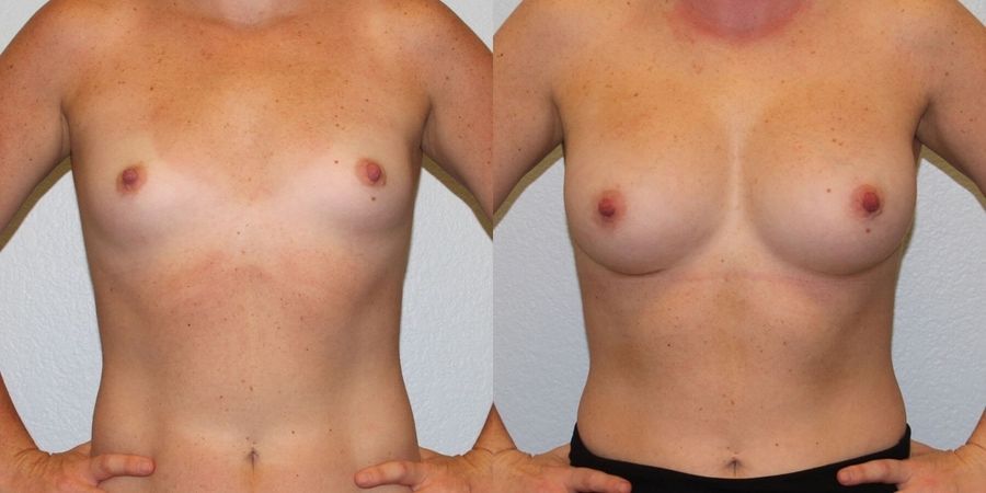 Breast Augmentation - Case 19324