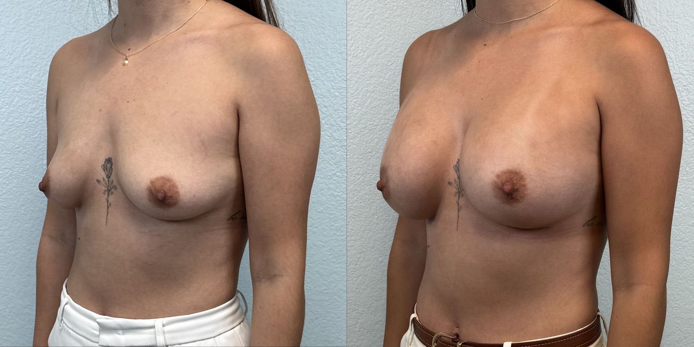 Breast Augmentation - Thumbnail 2