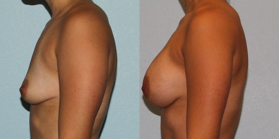 Breast Augmentation - Thumbnail 3