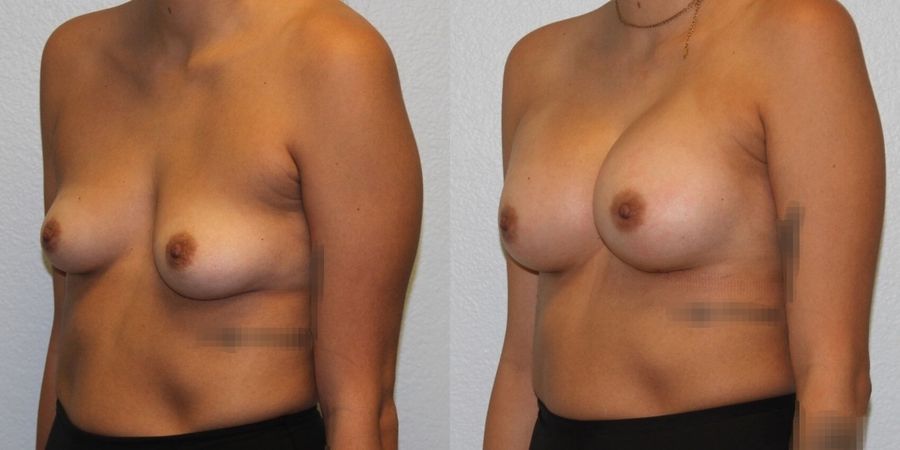 Breast Augmentation - Thumbnail 2