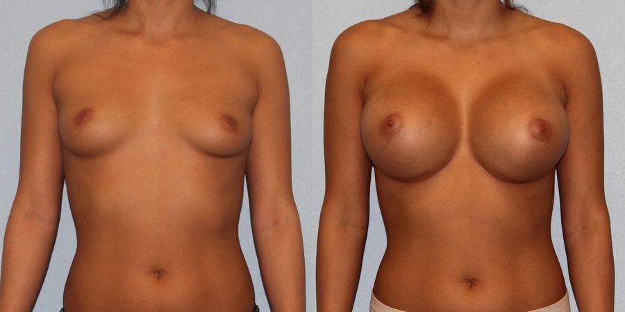Breast Augmentation - Case 19307