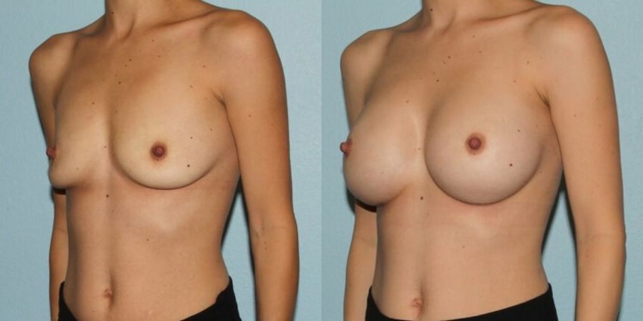 Breast Augmentation - Thumbnail 2