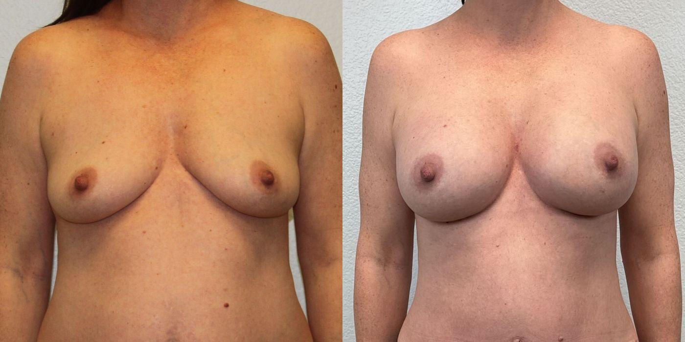 Breast Augmentation - Case 19257