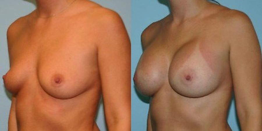 Breast Augmentation - Thumbnail 2
