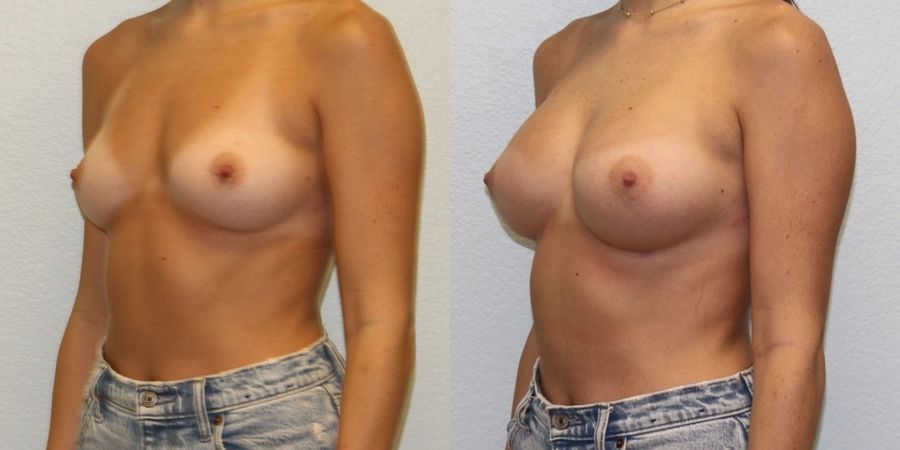 Breast Augmentation - Thumbnail 2