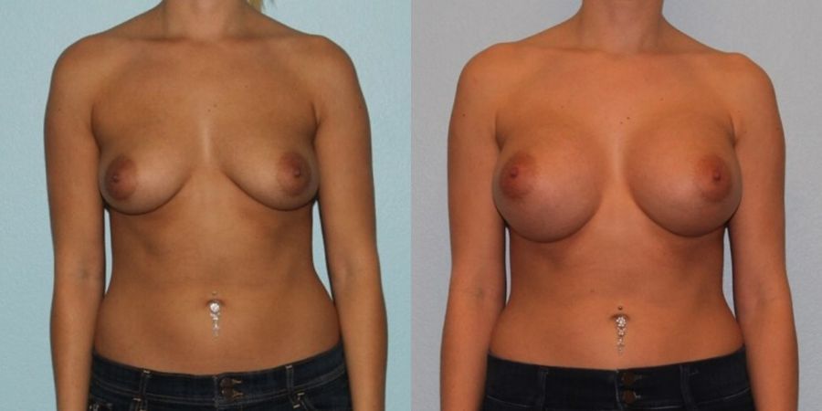 Breast Augmentation - Case 19338
