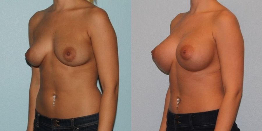 Breast Augmentation - Thumbnail 2