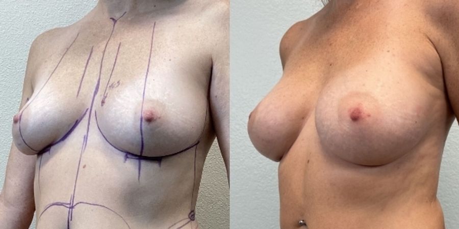 Breast Augmentation - Case 19349
