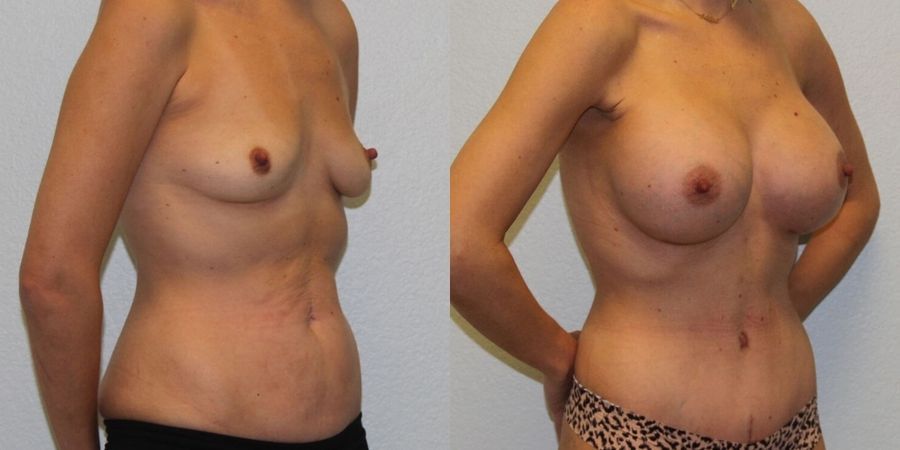 Breast Augmentation - Thumbnail 2