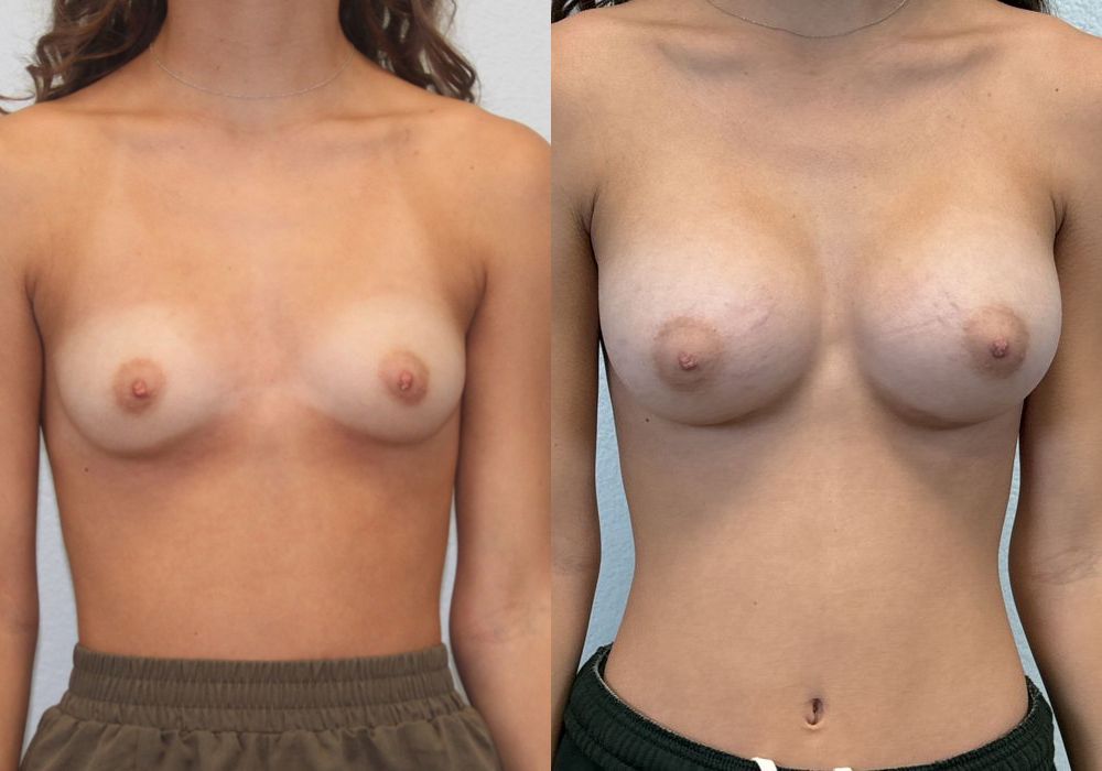 Breast Augmentation - Case 19350