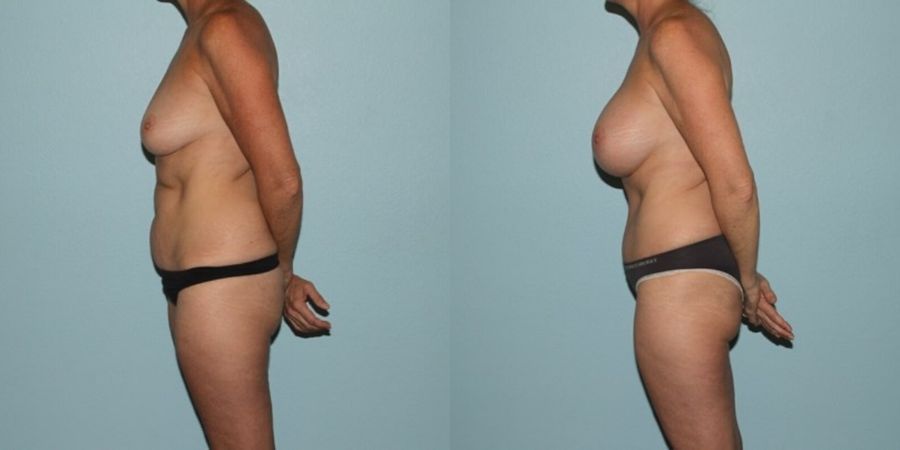 Breast Augmentation - Thumbnail 3