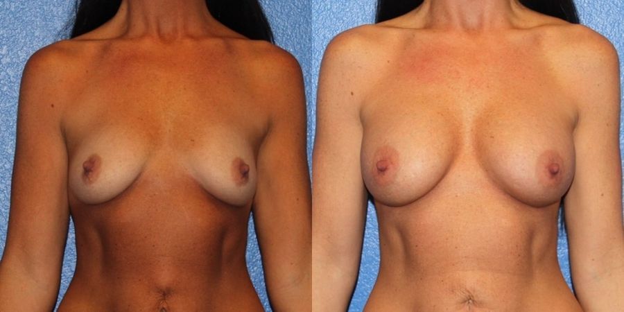 Breast Augmentation - Case 19328