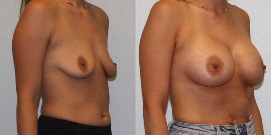 Breast Augmentation - Thumbnail 2