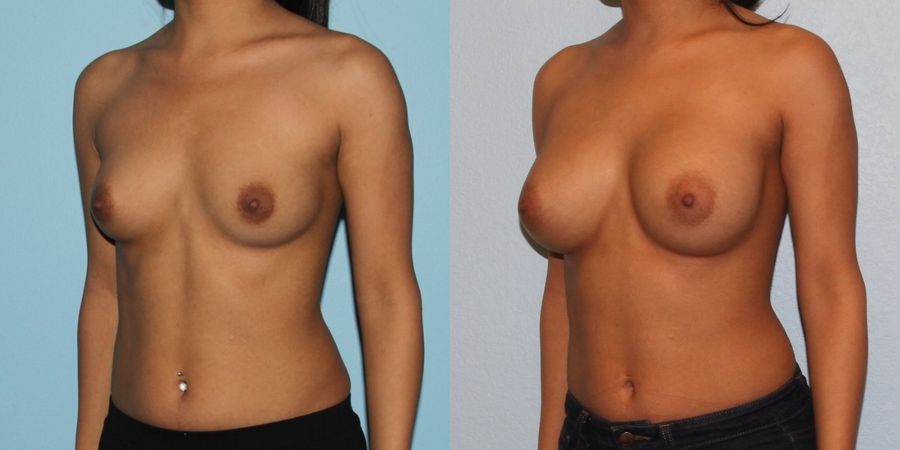 Breast Augmentation - Thumbnail 2