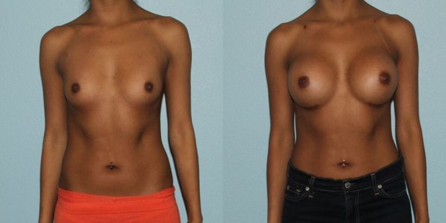 Breast Augmentation - Case 19335