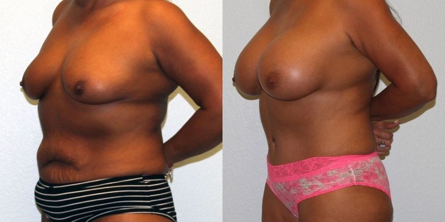 Breast Augmentation - Thumbnail 2