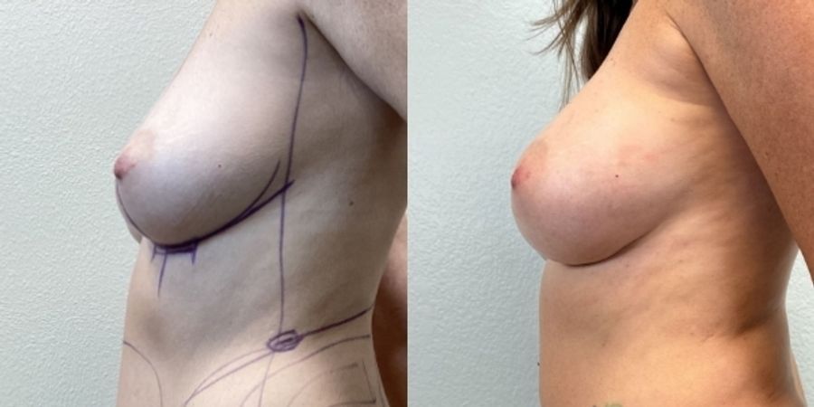 Breast Augmentation - Thumbnail 2