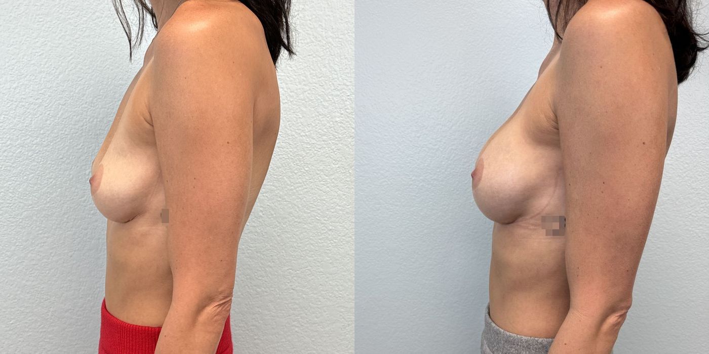 Breast Augmentation - Thumbnail 3