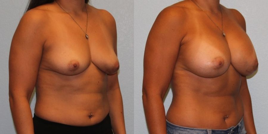 Breast Augmentation - Thumbnail 2