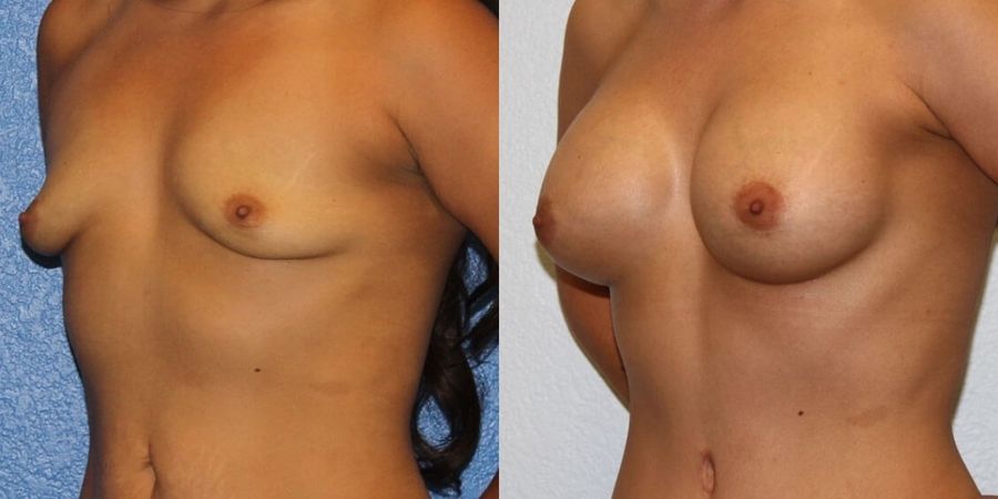 Breast Augmentation - Thumbnail 2