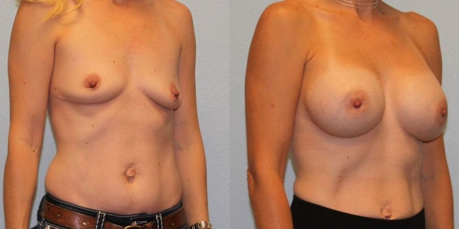 Breast Augmentation - Thumbnail 2