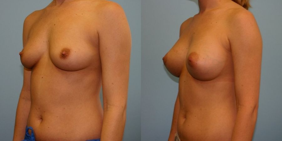 Breast Augmentation - Thumbnail 2