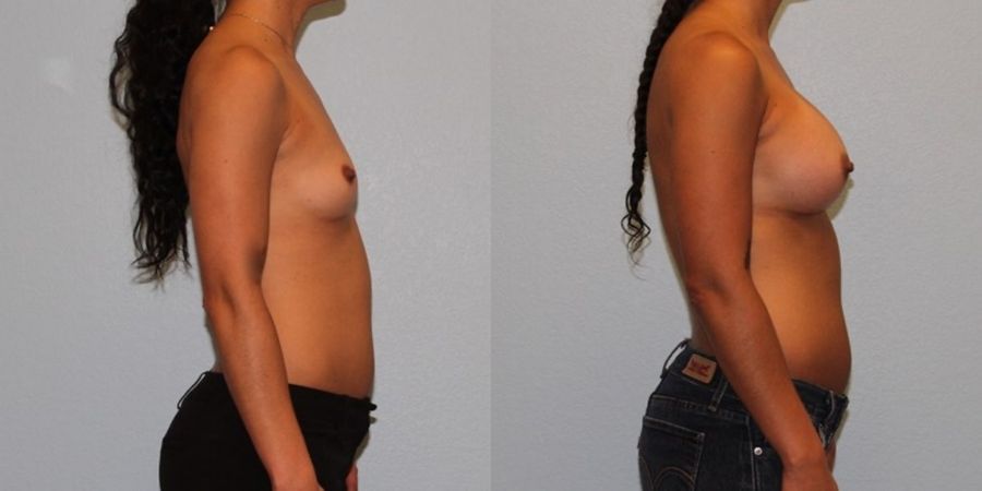 Breast Augmentation - Thumbnail 3