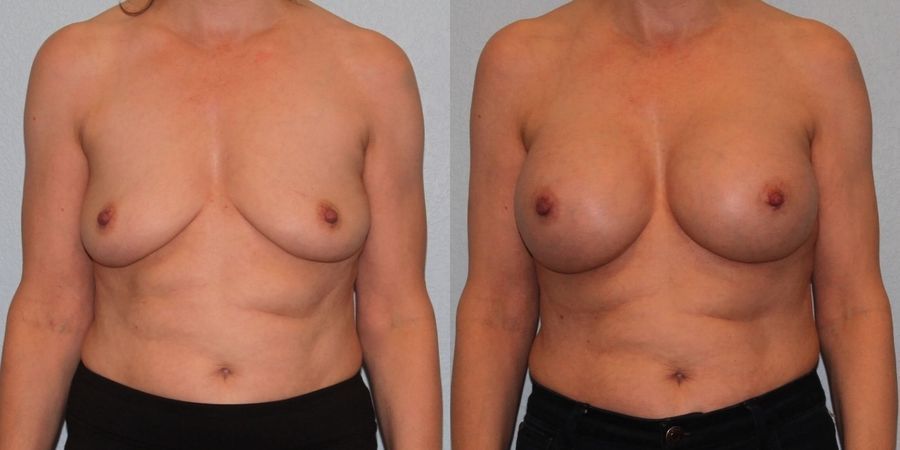 Breast Augmentation - Case 19305