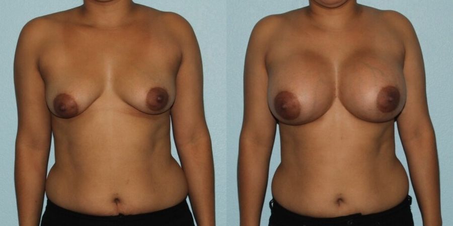 Breast Augmentation - Case 19327