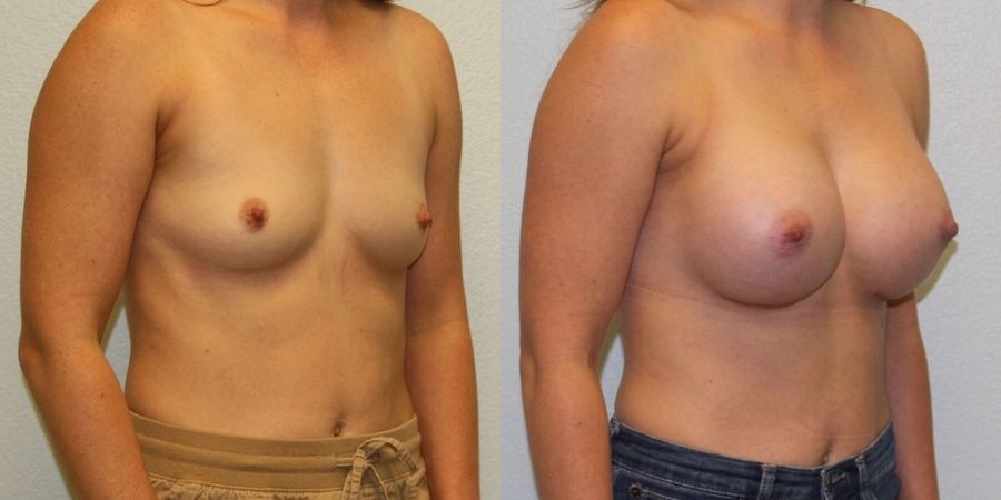 Breast Augmentation - Thumbnail 3