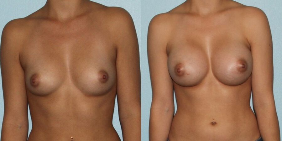 Breast Augmentation - Case 19294