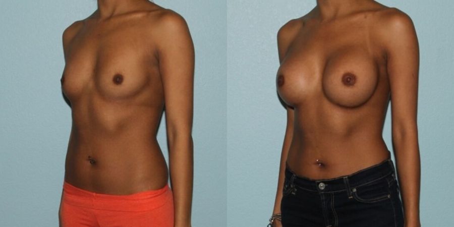 Breast Augmentation - Thumbnail 2