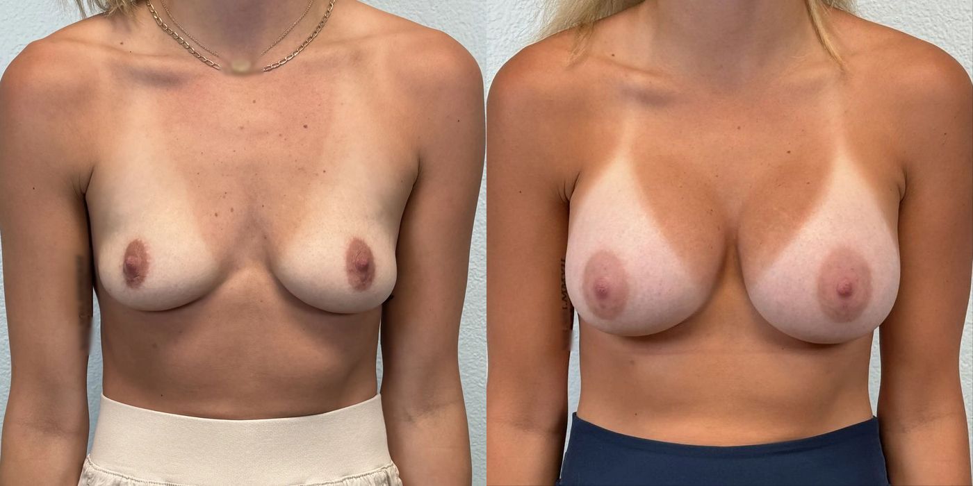 Breast Augmentation - Case 19252