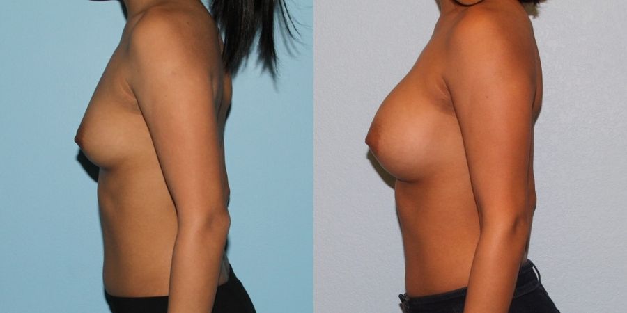 Breast Augmentation - Thumbnail 3
