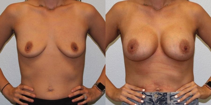 Breast Augmentation - Case 19321