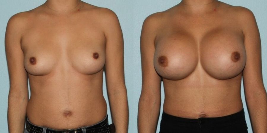 Breast Augmentation - Case 19285