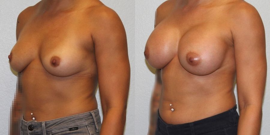 Breast Augmentation - Thumbnail 2